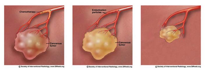 Chemoembolization