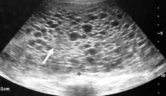 Gestational-trophoblastic