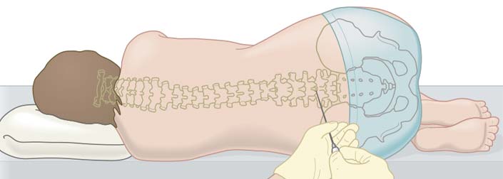 Intrathecal-chemotherapy