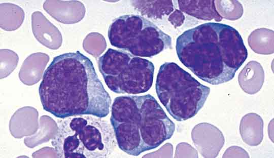 Non-Hodgkin-lymphoma